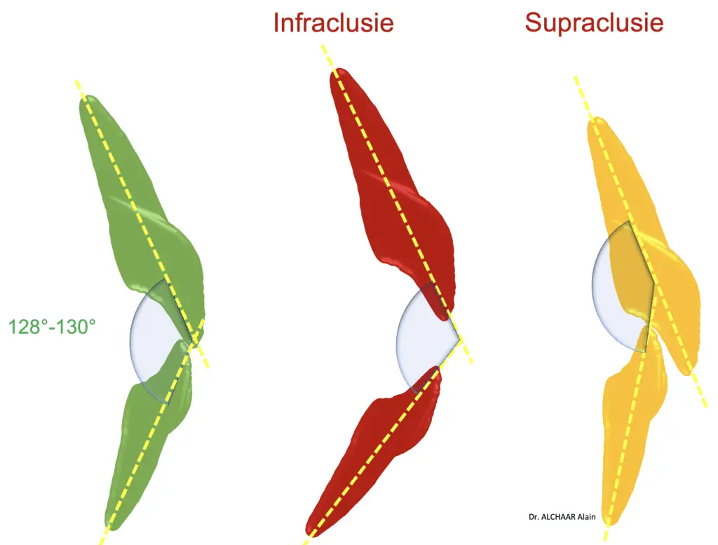 Infraclusie - Supraclusie ODF