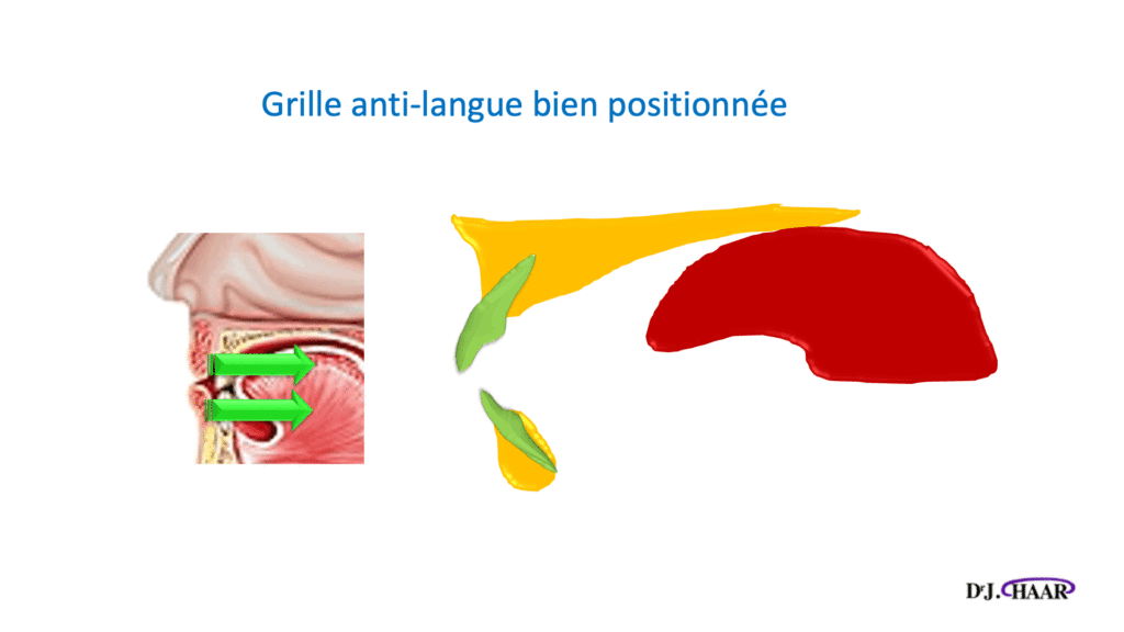 Grille Anti-langue position correcte