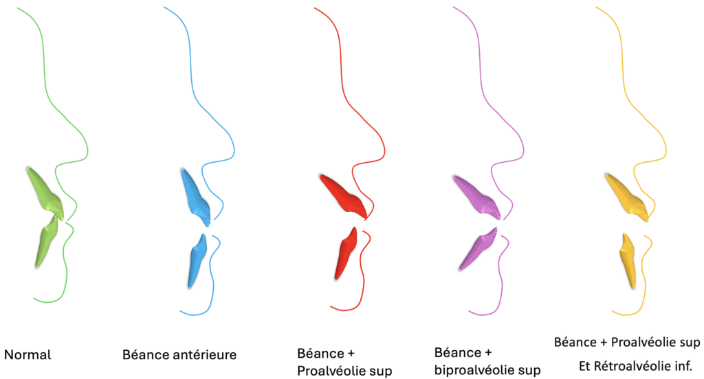 Les types des béances